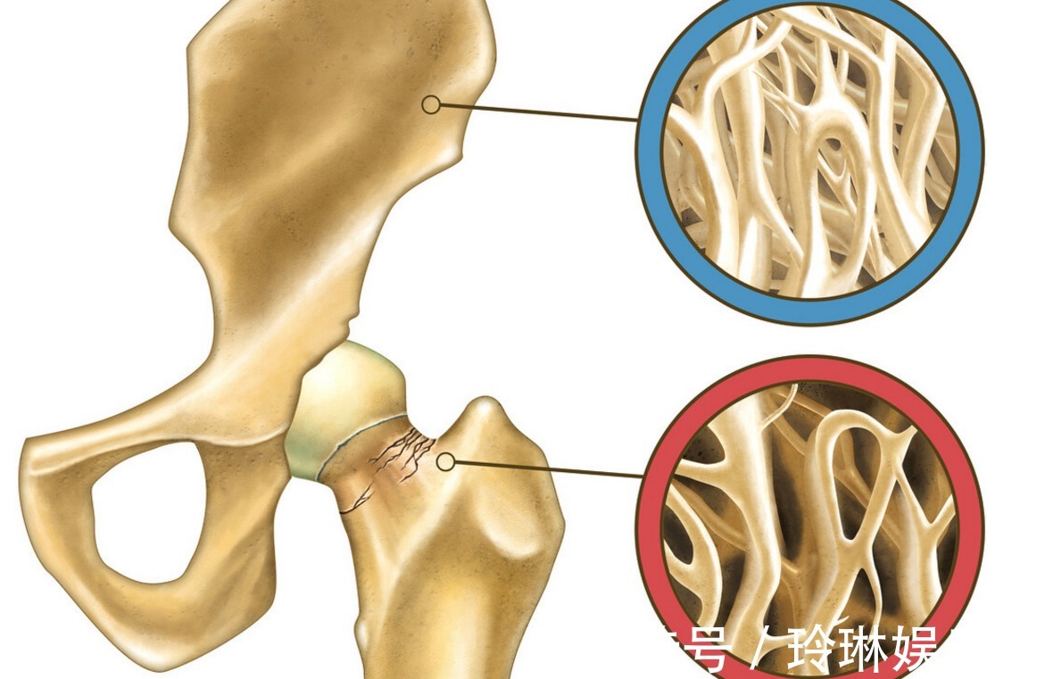 海带|骨质疏松不能吃豆腐？医生忠告：想要骨质稳固，3物尽早忌口