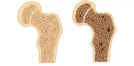 骨病专家提醒：骨疏松并不可怕，2种美味对骨好，骨骼慢慢变正常
