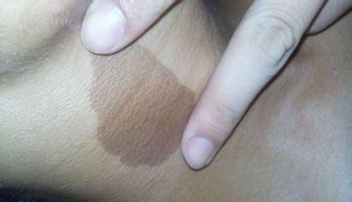 危害|胎记是上帝的吻痕妇产科医生胎记形成的原因和危害,你得知道