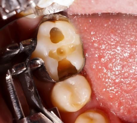 恒牙|10个5岁儿童中,7个有龋齿,罪魁祸首居然不是糖?