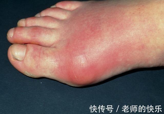 苏打饼干|高尿酸患者,医生提醒:常吃3种碱性食物,或可稳定尿酸