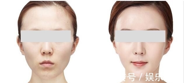 柔和 王小民教授:做完面部填充后,脸真的变小了?