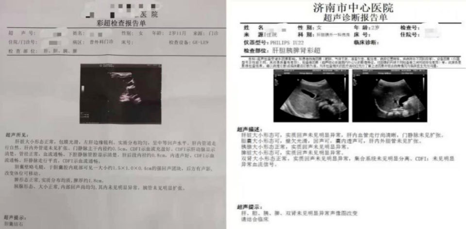 儿童|“不翼而飞”的儿童胆囊结石