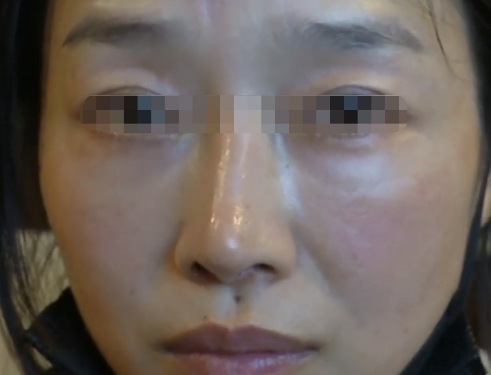 刘女士 花5万多做耳软骨隆鼻,女子术后竟不敢抬头!院方送你个双眼皮