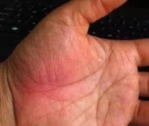 对症治疗|手掌上这块肉,一看就知道身体好不好!没事经常搓一搓,宣肺强心