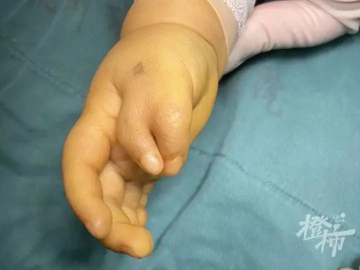 畸形|2岁男孩为啥长了一对“蟹钳”？手术后，妈妈的心结终于解开了