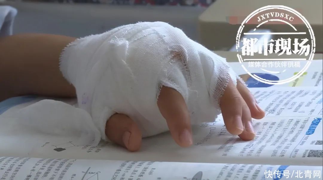 俊俊|男孩不小心弄断体温计，几天后手越来越肿，医生这样说