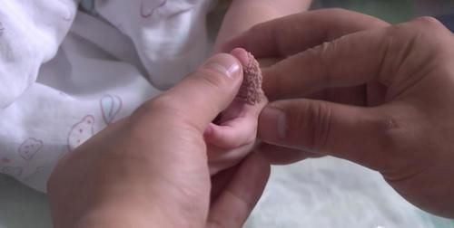 孩子|女婴多长一根手指,老人用土办法“治疗”,孩子差点要截肢