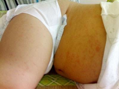 急疹|宝宝6个月后“第一次发烧”,大多是幼儿急疹,6-12个月娃要注意