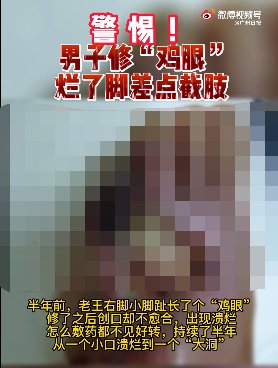 男子|警惕!糖尿病男子修鸡眼差点遭截肢,医生提醒