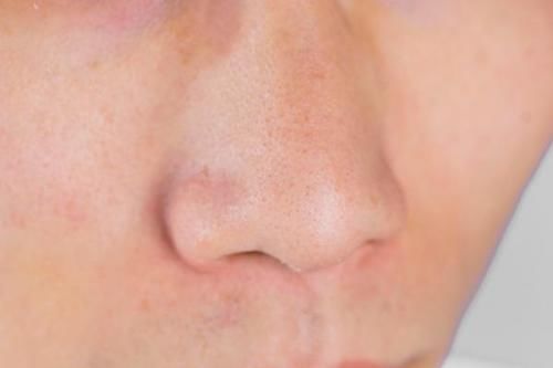 皮肤|鼻子两边经常挤出的“白色长条”,是什么东西?教你告别草莓鼻