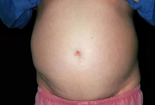 奶奶|10岁男孩,肚子鼓胀,查出肝癌,医生直言奶奶的疼爱害了他