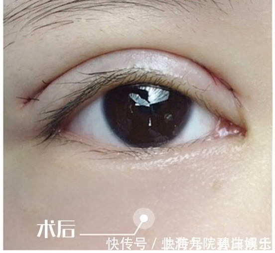 重睑线 眼修复孙沣博士:双眼皮术后是否会产生疤痕和增生?