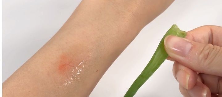 被蚊子咬了太痒难受教你一招,不用买药,快速止痒