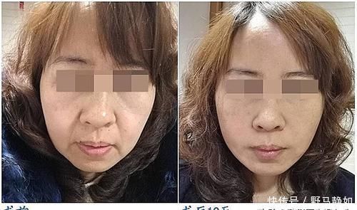 医生|40-50岁想做拉皮手术,医生细说一些真实有用的建议