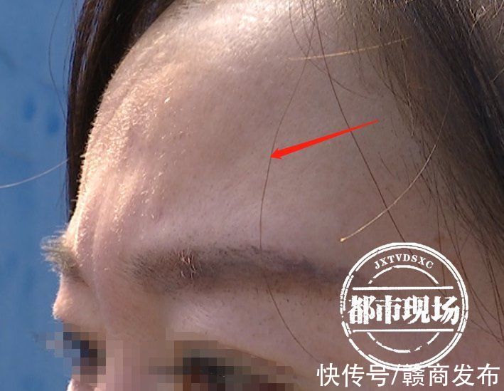 红谷滩区 女子在南昌“柠美”做手术能旺夫？术后财运没起色 额头多了坑