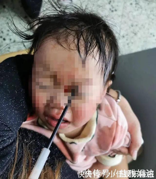 儿童|警惕这款网红玩具已致多名儿童颅脑损伤……