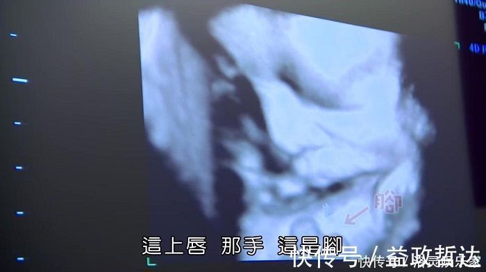 产科医生|剖腹产没半年又怀孕,孕30周后子宫破裂,大人保住了孩子却没了