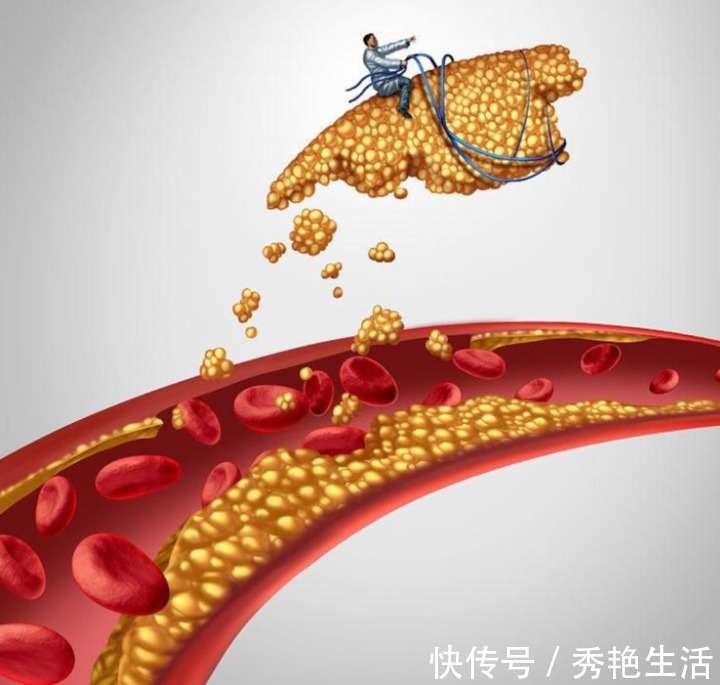 高脂血癥|血脂久高不下如何調理中醫常見4種降脂中藥，附食療小建議