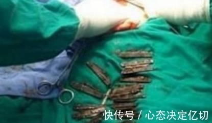 医生|男子深夜吐血，手术开刀后，发现肚子里的东西在场医生?傻住