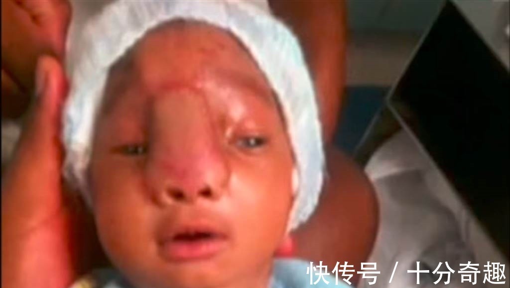 帅哥|婴儿大脑长头颅外 手术后变小帅哥萌歪所有人