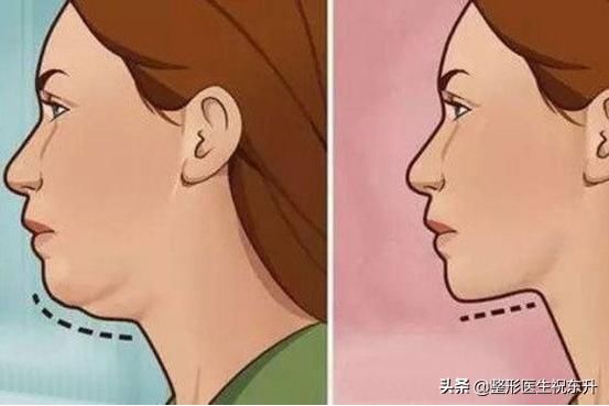 怎么提升侧颜的高级感？医生来支招：找回消失的下颌线
