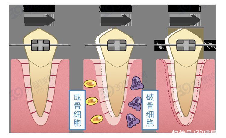 矫正|为什么只要戴牙套，牙齿就可以恢复得很整齐？生动展示矫正过程