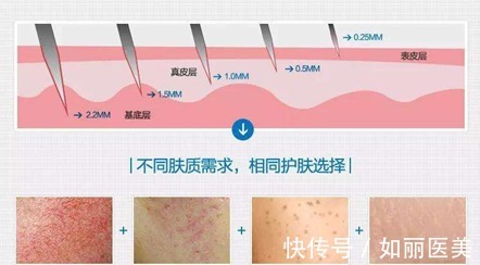 大干皮 水光针、微针、光子嫩肤、皮秒有什么作用,该怎么选?