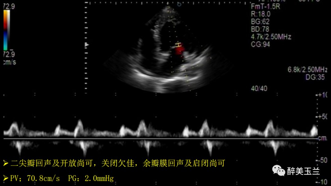 扩张型心肌病患者非心脏手术的全身麻醉一例|病例讨论 | 全身麻醉