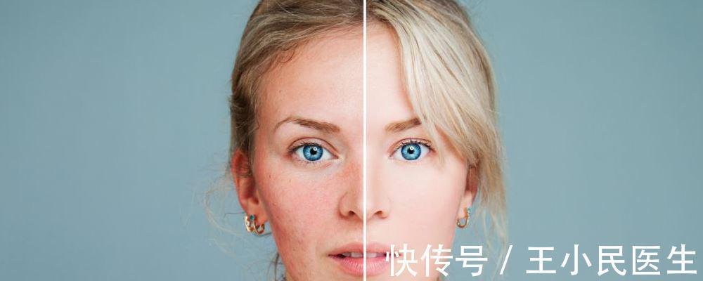 除皱|王小民教授:做小拉皮的人逐渐增多,网上传言却没有效果?