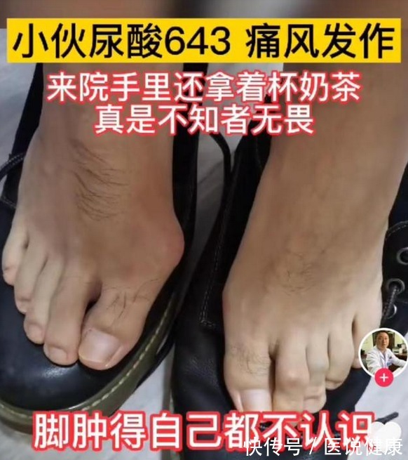 关节|小伙经常喝奶茶,尿酸达到643?避免痛风,这4类食物同样也得忌口
