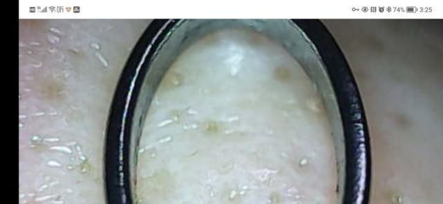 青春|洁净看得见,让青春轻松战“痘”: 媄拾智能可视毛孔清洁仪