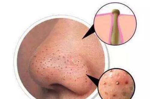 草莓鼻|鼻尖挤出“白色条状物”?学会3招,趁早和“草莓鼻”说再见