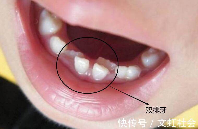 双排牙|最全儿童换牙时间表:儿童换牙何时开始、何时结束?一图说清