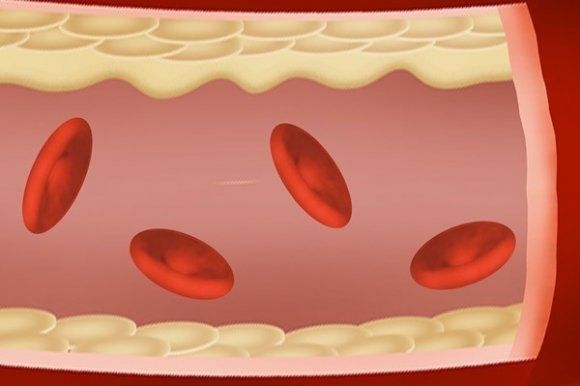 炎症|血脂不高,为啥医生还让吃他汀?预防血管堵塞,医生教你好方法