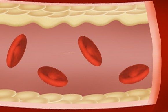 炎症|血脂不高，为啥医生还让吃他汀？预防血管堵塞，医生教你好方法