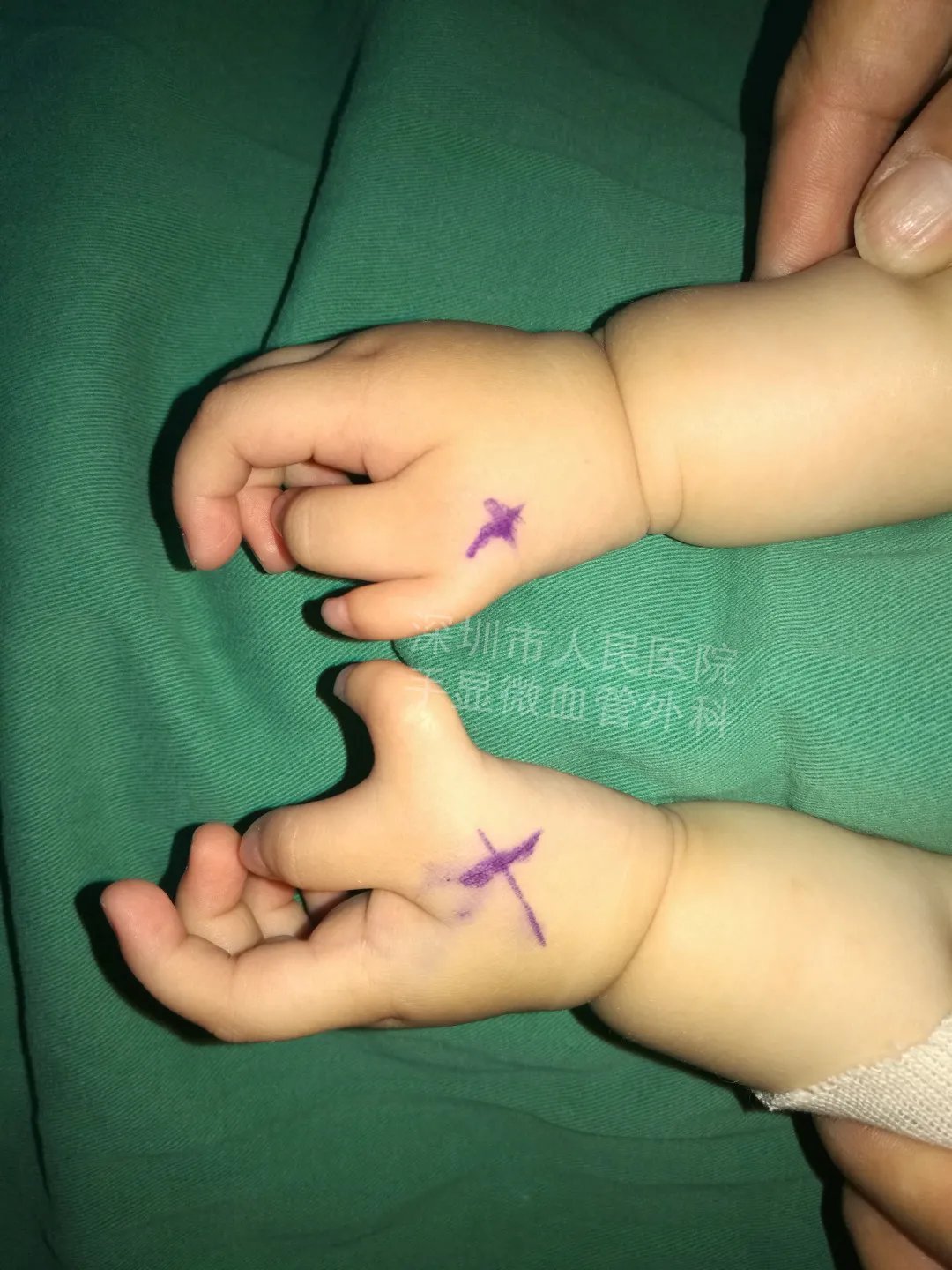 发育不良|得了这病,12岁男孩手指比香蕉还粗!7种常见的手部畸形,家长们要注意