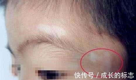 蛔虫|男童总闹肚子疼不吃饭，脸上莫名起白斑，宝妈送医后恍然大悟！