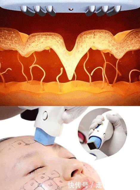 拉皮 拉皮手术“落伍”了,早都“过时”了!