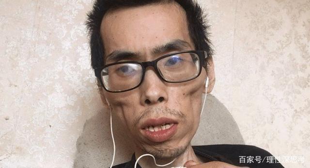 直肠癌|抗癌小伙阿健去世，请将他这份乐观在社会上传递下去