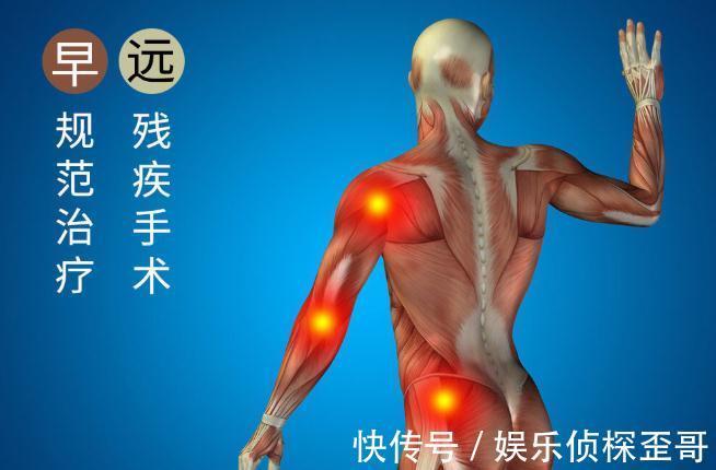 关节炎|晚期关节炎能靠人工关节置换术夺回健康?医生讲明不早用的理由