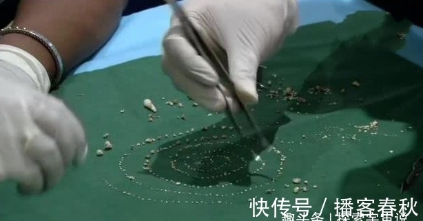 怪物|七岁男孩嘴中有526颗牙齿,医生花费5小时取出,和怪物没区别