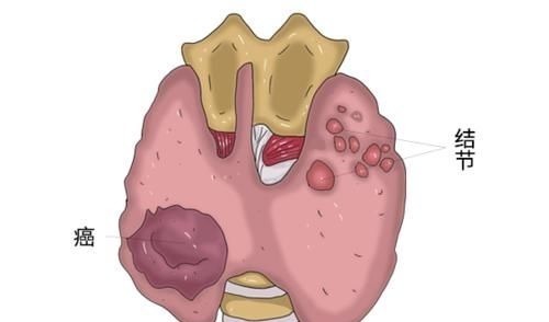 癌症|癌细胞明明已经扩散,为什么人依旧很精神,吃的也比较多?