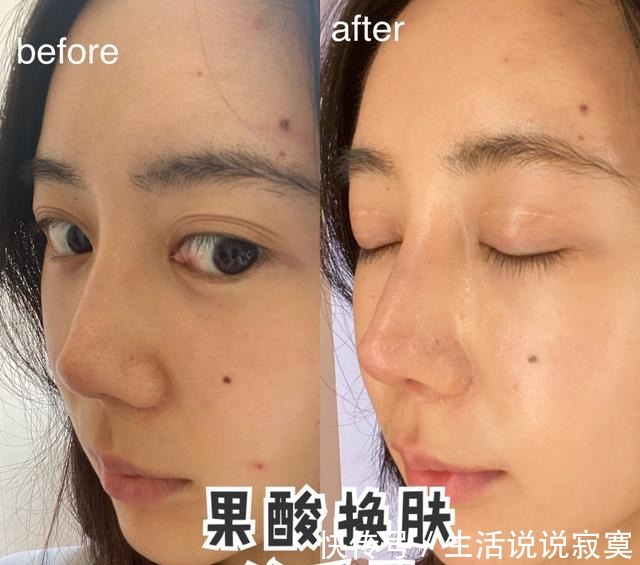 护肤品 果酸术后超全护理大全!