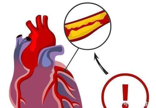 高血脂|甘油三酯这么降最快,3个月从62降到15,高血脂不攻自破