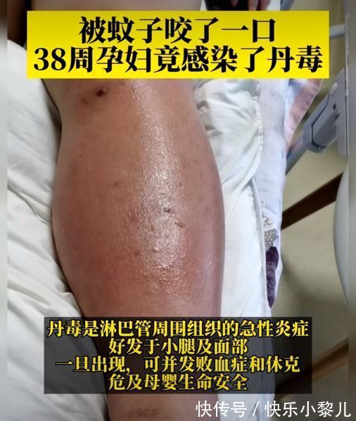 孕检|孕妇被蚊子咬了一口,胎儿性命垂危,小细节不注意要人命!