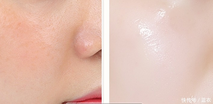 皮肤|鼻上黑头别傻傻再用手挤,皮肤科医生教你一招,让黑头自动流出来!