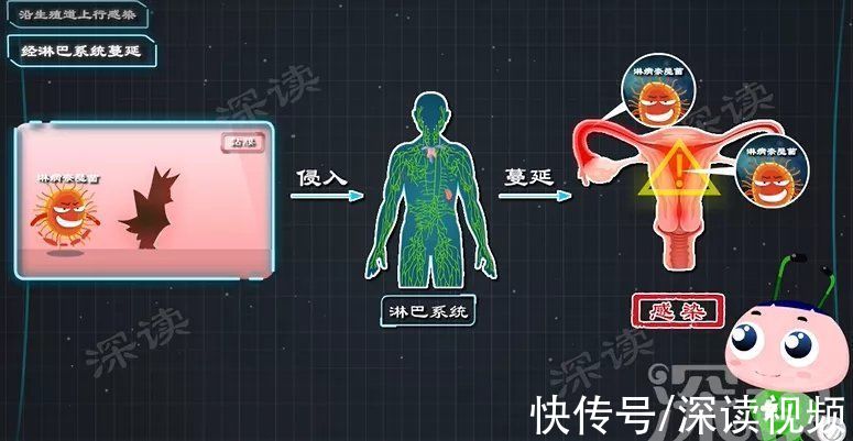 病原體|性生活過頻、人流手術會引發盆腔炎？生活中哪些事易招惹盆腔炎？