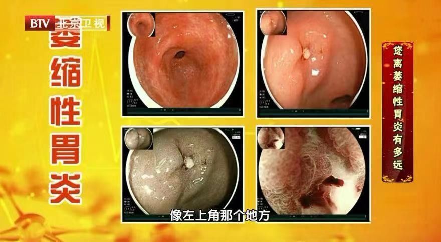 胃病|胃病无小事，一不小心可能拖成癌！有这些迹象要及时就诊