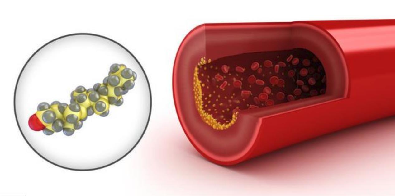 血脂异常|甘油三酯高，什么方法能够迅速减低2个具体实例，教你综合调理